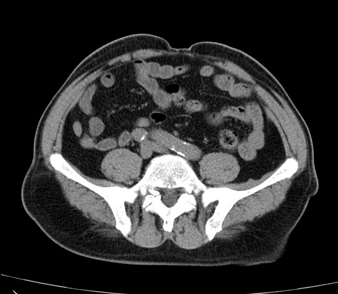 File:Abdominal aortic aneurysm (Radiopaedia 22421-22458 non-contrast 37).jpg