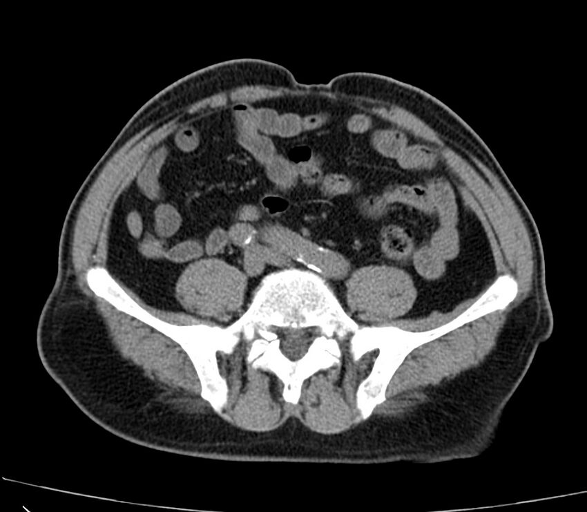 Abdominal aortic aneurysm (Radiopaedia 22421-22458 non-contrast 37).jpg