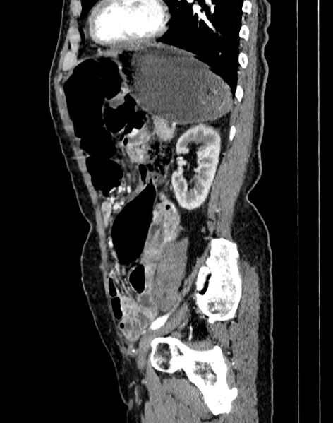 File:Abdominal aortic aneurysm (Radiopaedia 83581-98689 Sagittal C+ arterial phase 85).jpg