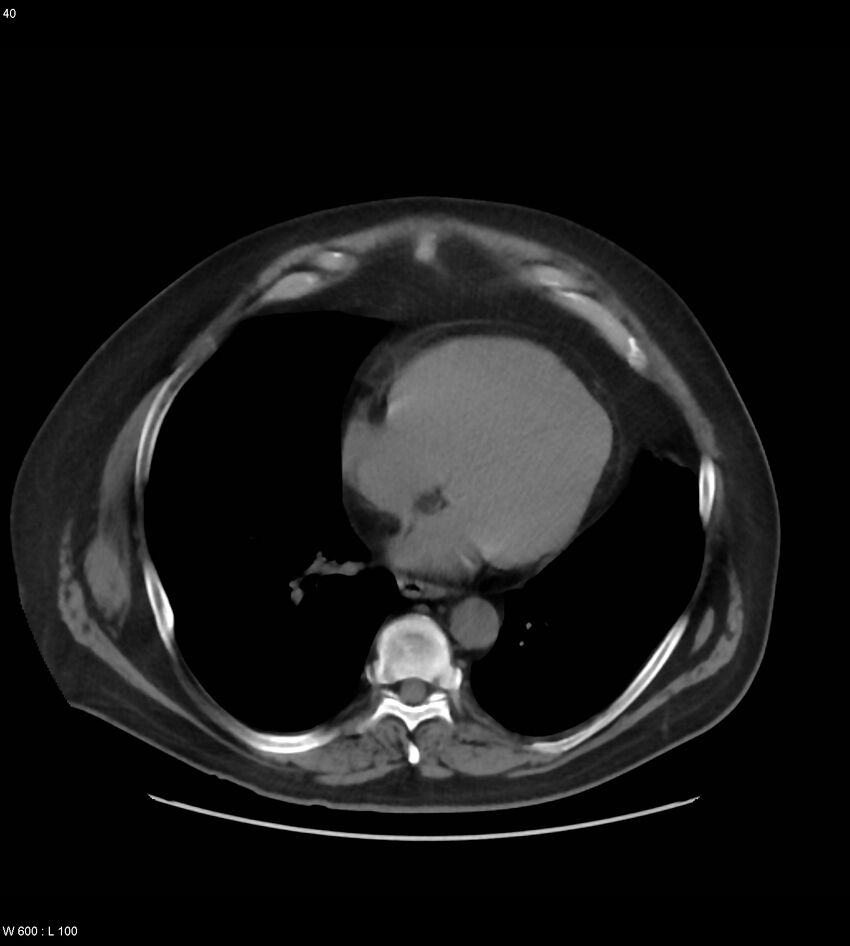 Abdominal aortic aneurysm with intramural hematoma then rupture (Radiopaedia 50278-55631 Axial non-contrast 36).jpg