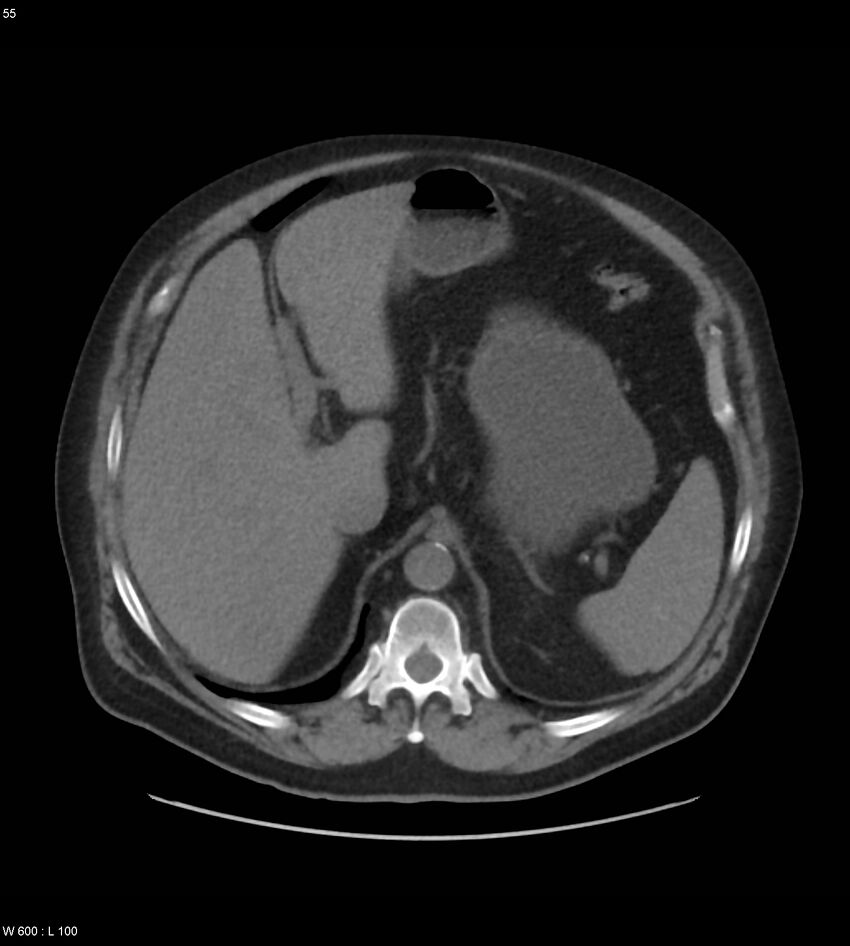 Abdominal aortic aneurysm with intramural hematoma then rupture (Radiopaedia 50278-55631 Axial non-contrast 51).jpg