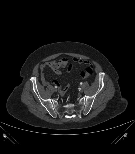 File:Abdominal aortic aneurysm with thrombus fissuration (Radiopaedia 46218-50618 Axial C+ arterial phase 34).jpg