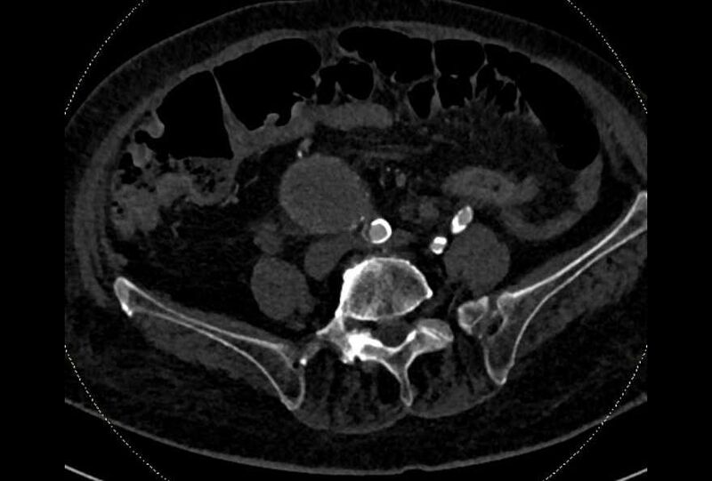 File:Abdominal aortic aneurysm with thrombus fissuration (Radiopaedia 73192-83919 Axial C+ arterial phase 147).jpg