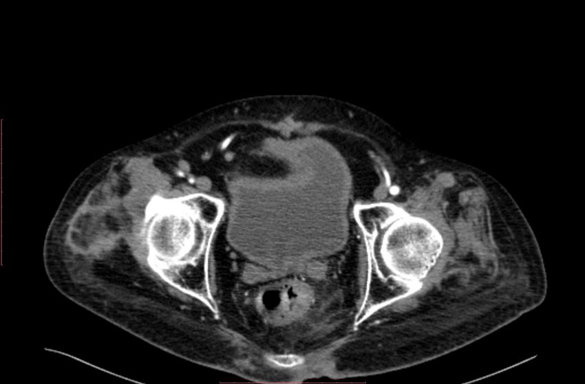Abdominal aortic interposition tube graft and aneurysm thrombosis (Radiopaedia 71438-81857 Axial C+ arterial phase 223).jpg