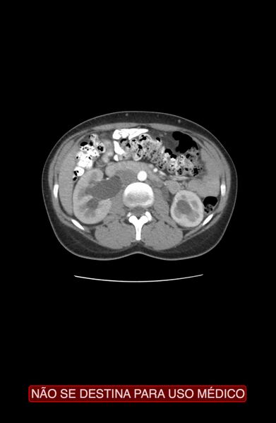File:Abdominal desmoid tumor (Radiopaedia 44024-47540 Axial C+ arterial phase 8).jpg