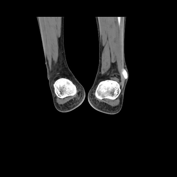 File:Accessory soleus muscle (Radiopaedia 61069-68943 Coronal non-contrast 61).jpg