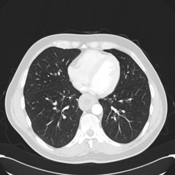 File:Achalasia (Radiopaedia 24937-25206 Axial lung window 23).jpg