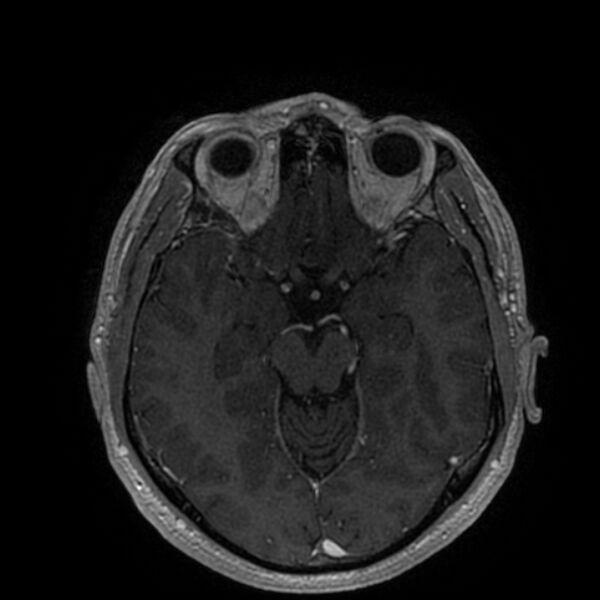 File:Acoustic schwannoma - intracanalicular (Radiopaedia 37247-39024 Axial T1 C+ 104).jpg