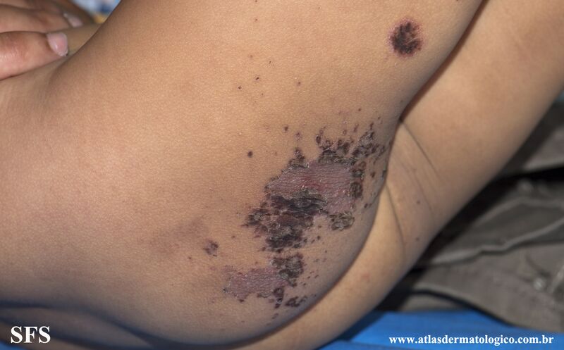 File:Acrodermatitis Enteropathica (Dermatology Atlas 63).jpg