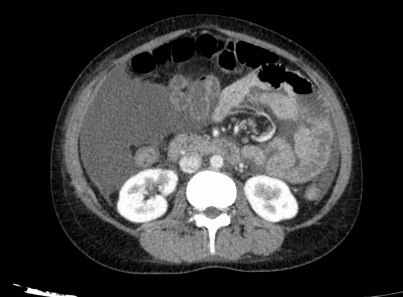 File:Acute Budd-Chiari syndrome (Radiopaedia 60858-68638 Axial C+ portal venous phase 145).jpg