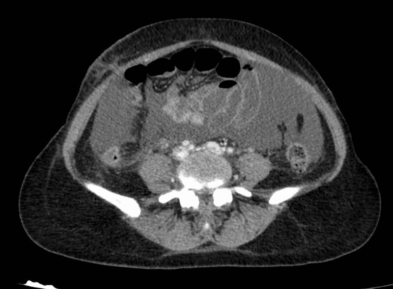 File:Acute Budd-Chiari syndrome (Radiopaedia 60858-68638 Axial C+ portal venous phase 200).jpg