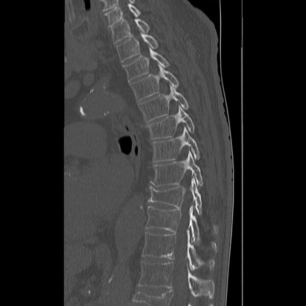 File:Acute and chronic vertebral compression fractures (Radiopaedia 31608-32494 Sagittal bone window 18).jpg