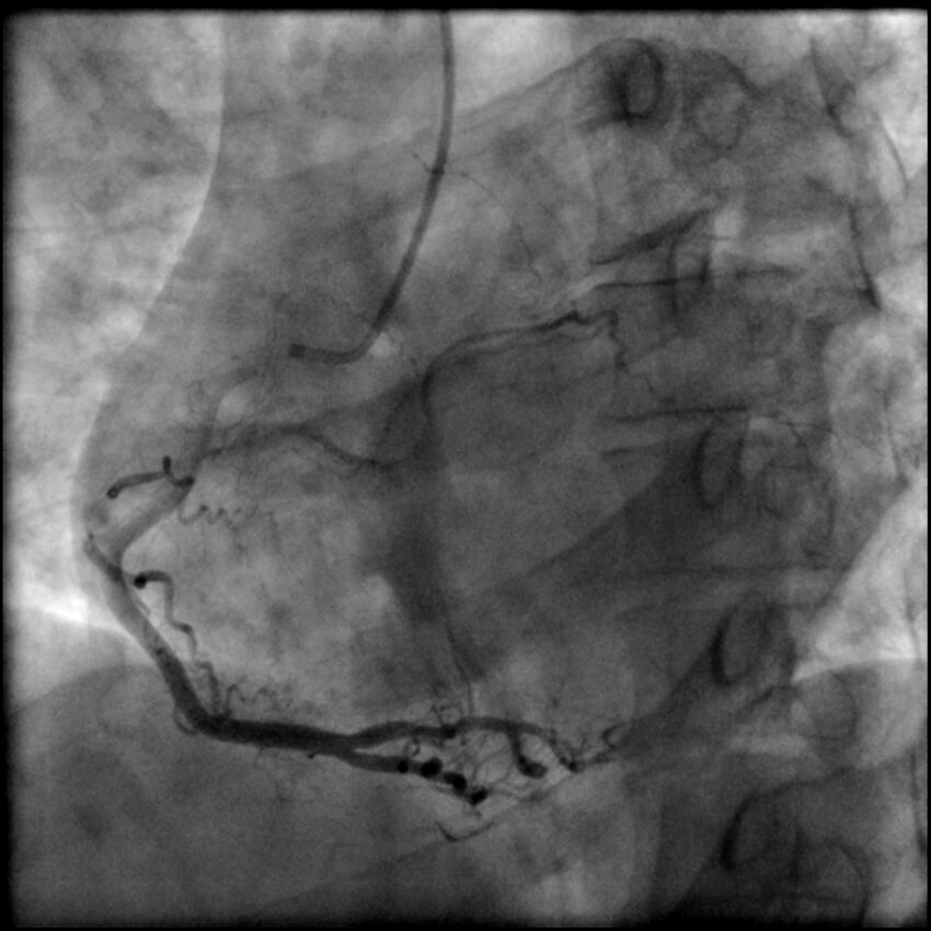 Acute anteroseptal myocardial infarction (Radiopaedia 68409-77946 RAO straight RCA 45).jpg