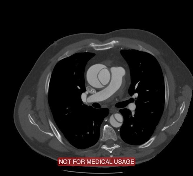 File:Acute aortic dissection - Stanford type A (Radiopaedia 40661-43285 Axial C+ arterial phase 25).jpg