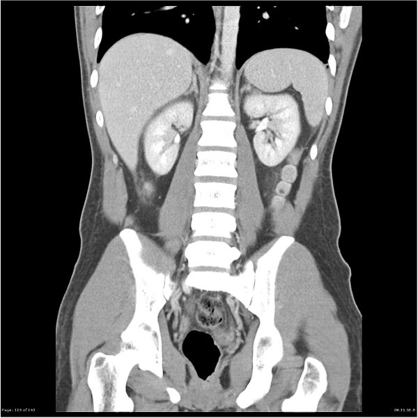 File:Acute appendicitis (Radiopaedia 25364-25615 C+ portal venous phase 20).jpg