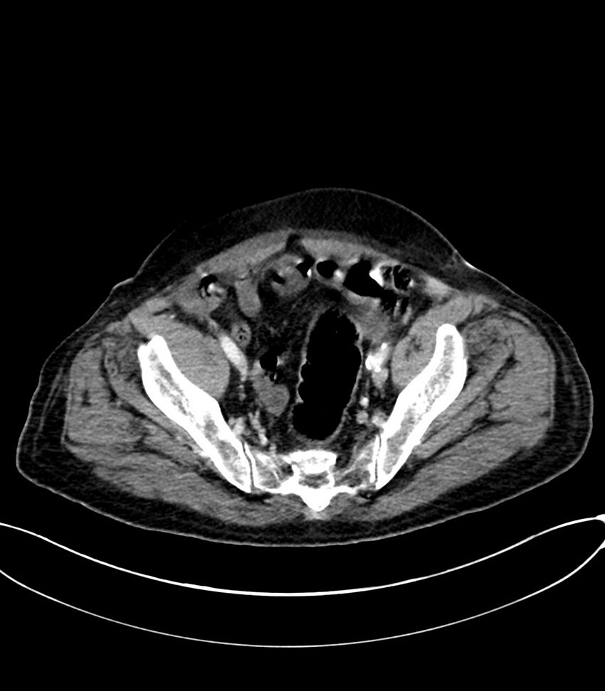 Acute arterial mesenteric ischemia (Radiopaedia 78238-90828 Axial C+ portal venous phase 119).jpg