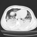 Acute aspiration pneumonitis (Radiopaedia 33605-34703 Axial lung window 67).jpg