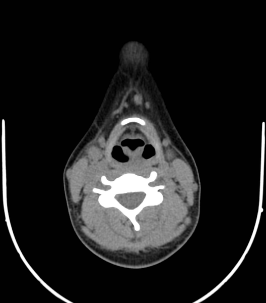 File:Acute bacterial tonsillitis (Radiopaedia 22882-22908 Axial non-contrast 36).png