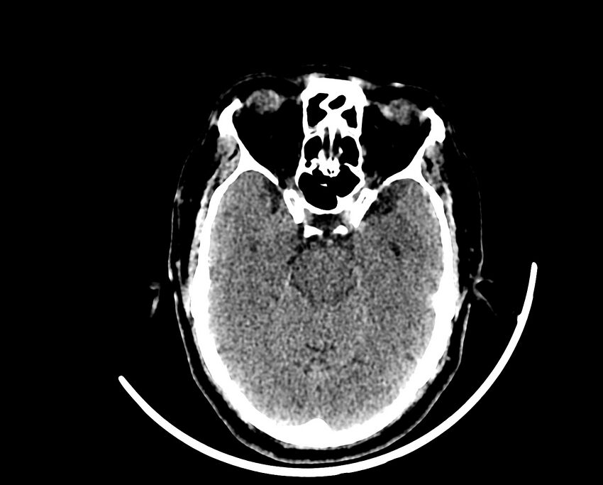 Acute cerebral infarct (Radiopaedia 35604-37123 Axial non-contrast 35).jpg