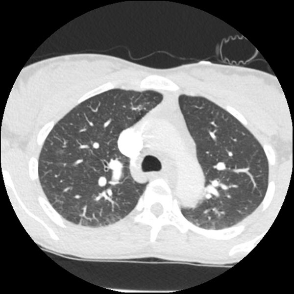 File:Acute chest syndrome - sickle cell disease (Radiopaedia 42375-45499 Axial lung window 63).jpg