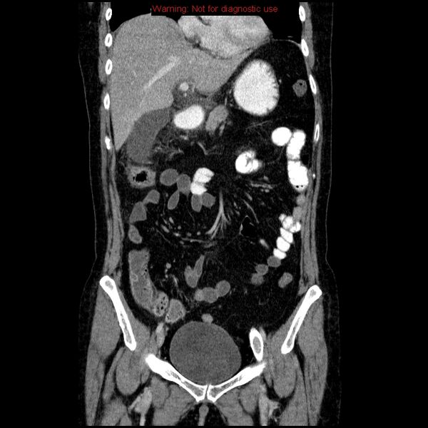 File:Acute gangrenous cholecystitis (Radiopaedia 10123-10661 Coronal C+ portal venous phase 7).jpg