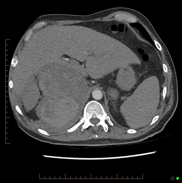 File:Acute hemorrhage into adrenal metastasis from NSCLC (Radiopaedia 43135-46429 Axial C+ CTPA 11).jpg