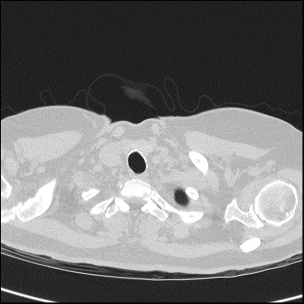 File:Acute interstitial pneumonitis (Radiopaedia 45404-49453 Axial lung window 4).jpg