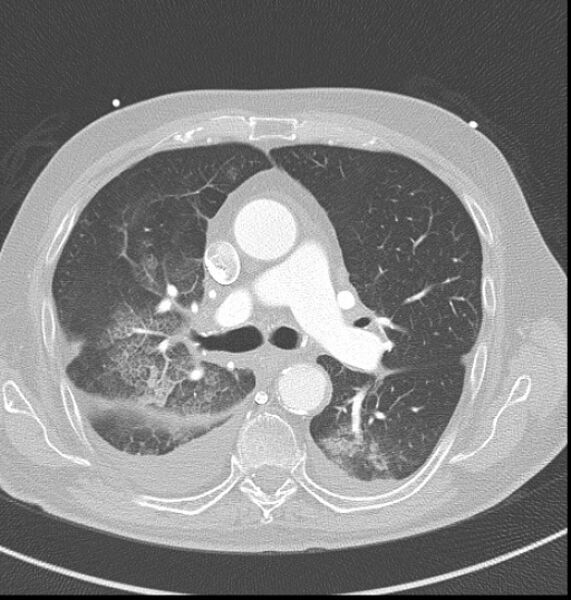 File:Acute myocardial infarction (Radiopaedia 23413-23481 lung window 18).jpg