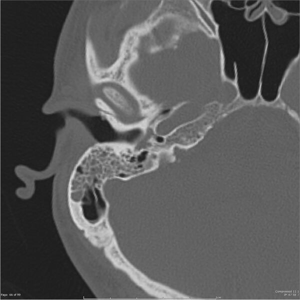 File:Acute otomastoiditis (Radiopaedia 28276-28512 Axial PTB bone window reformat 46).jpg
