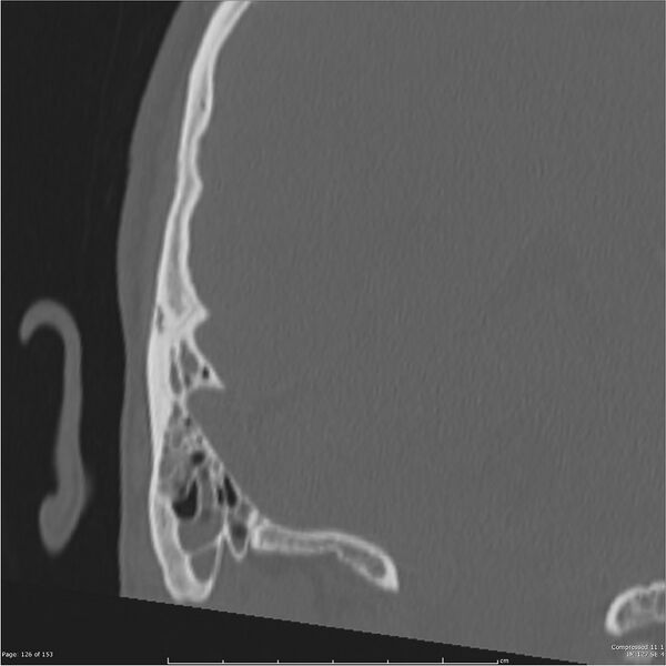 File:Acute otomastoiditis (Radiopaedia 28276-28512 Coronal PTB bone window reformat 57).jpg