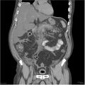 Acute pancreatitis (Radiopaedia 19135-19116 Coronal non-contrast 16).jpg