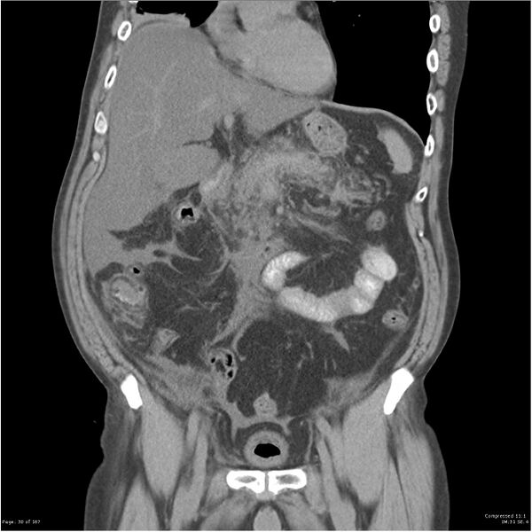 File:Acute pancreatitis (Radiopaedia 19135-19116 Coronal non-contrast 16).jpg