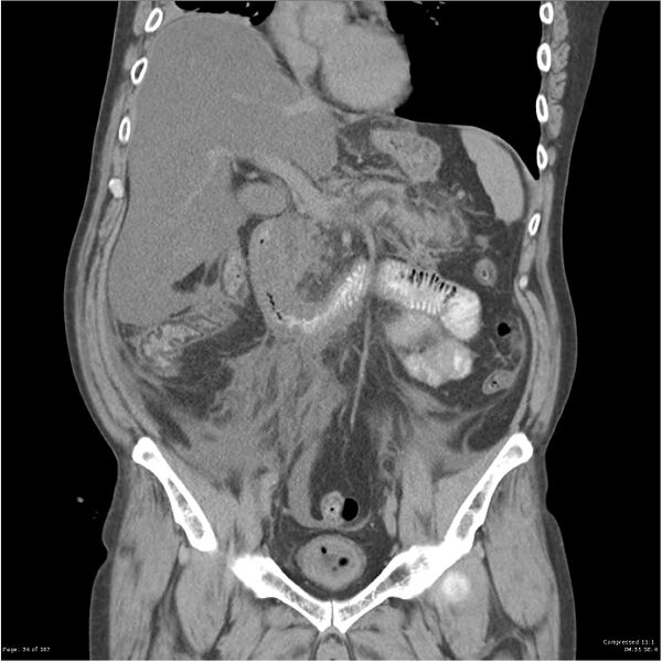 File:Acute pancreatitis (Radiopaedia 19135-19116 Coronal non-contrast 20).jpg