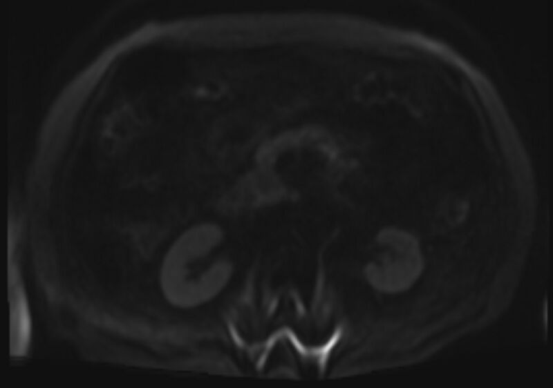 File:Acute portal vein thrombosis (Radiopaedia 73198-83925 Axial DWI 80).jpg
