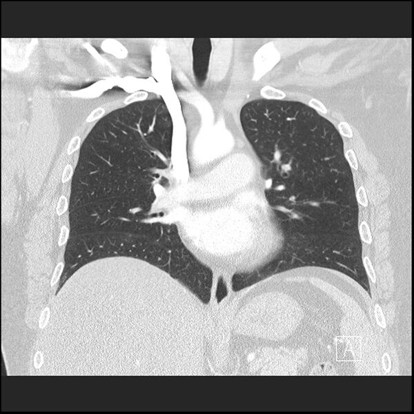 File:Acute pulmonary embolism with pulmonary infarct (Radiopaedia 73062-83768 Coronal lung window 38).jpg