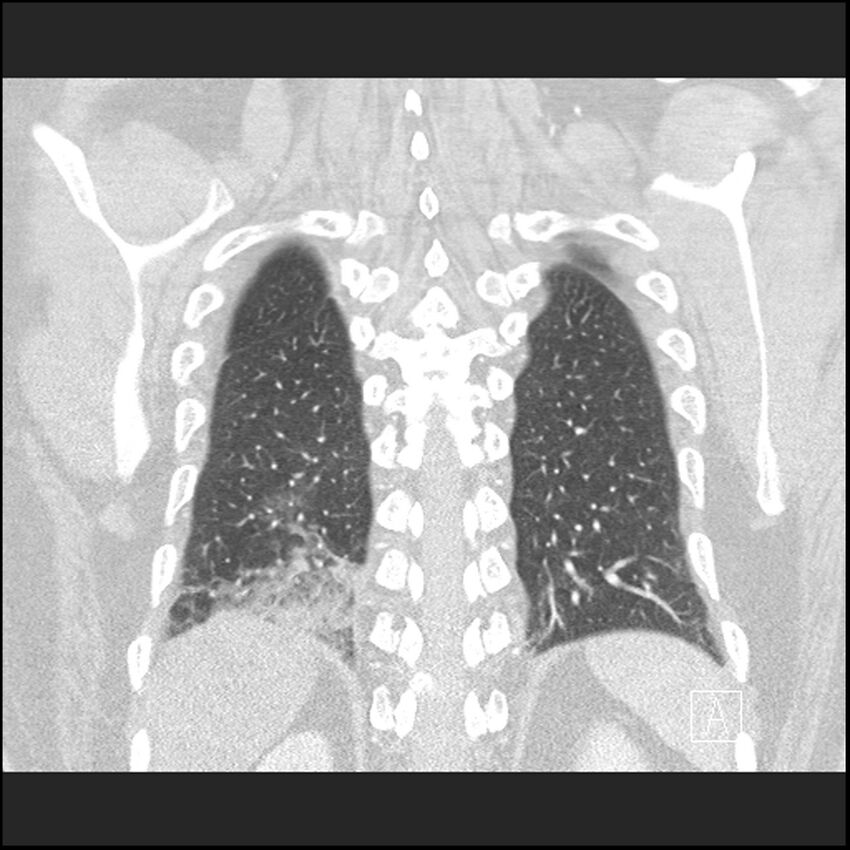 Acute pulmonary embolism with pulmonary infarct (Radiopaedia 73062-83768 Coronal lung window 63).jpg