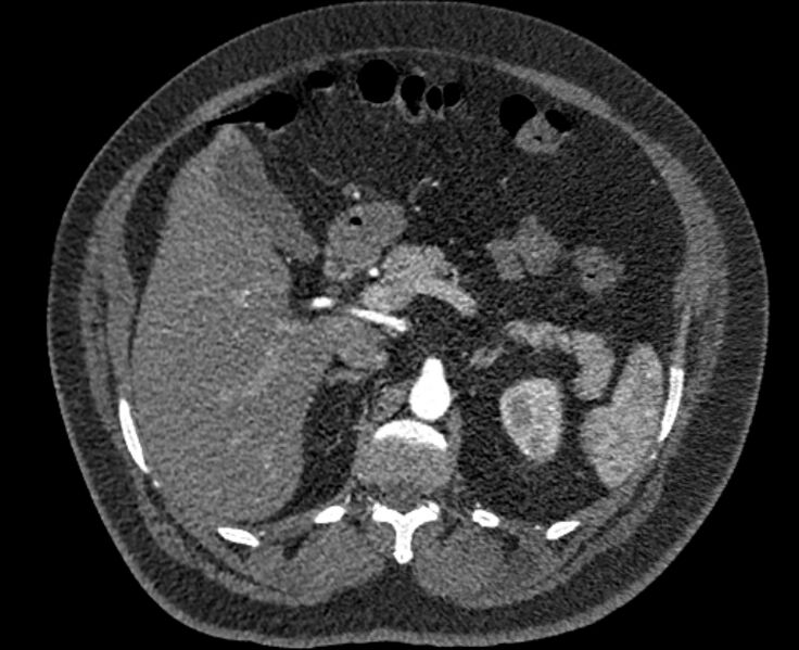 File:Acute pulmonary embolism with pulmonary infarcts (Radiopaedia 77688-89908 Axial C+ CTPA 81).jpg