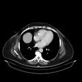 Acute pyelonephritis (Radiopaedia 25657-25837 Axial renal parenchymal phase 5).jpg