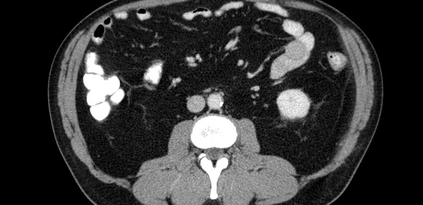 Acute sigmoid colon diverticulitis (Radiopaedia 55507-61976 Axial C+ portal venous phase 15).jpg