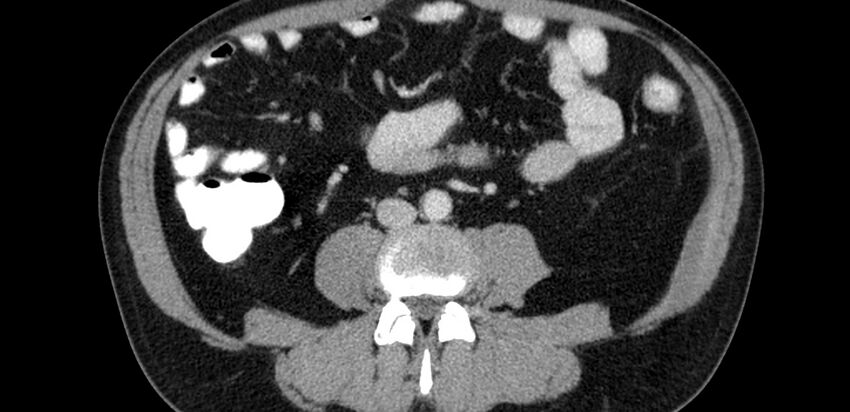 Acute sigmoid colon diverticulitis (Radiopaedia 55507-61976 Axial C+ portal venous phase 36).jpg