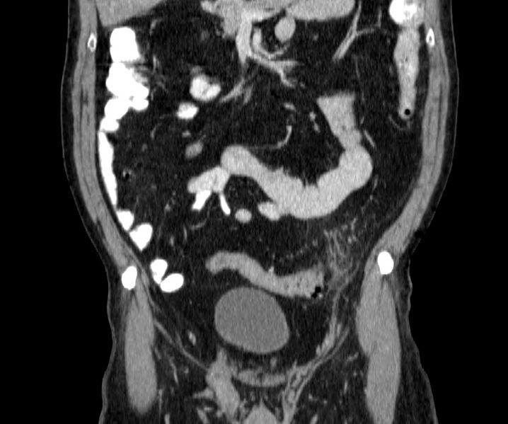 File:Acute sigmoid colon diverticulitis (Radiopaedia 55507-61976 Coronal C+ portal venous phase 50).jpg