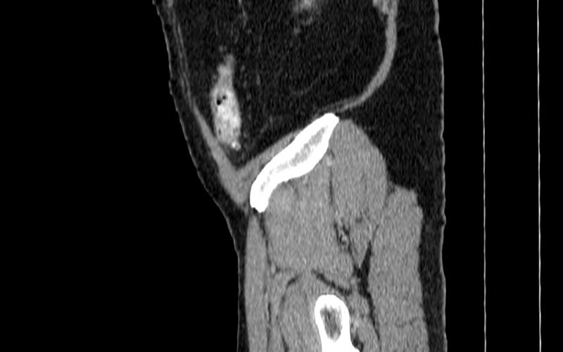 File:Acute sigmoid colon diverticulitis (Radiopaedia 55507-61976 Sagittal C+ portal venous phase 130).jpg