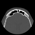 Acute sinusitis (Radiopaedia 23161-23215 Axial bone window 68).jpg