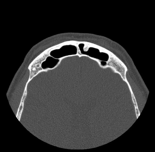 File:Acute sinusitis (Radiopaedia 23161-23215 Axial bone window 68).jpg