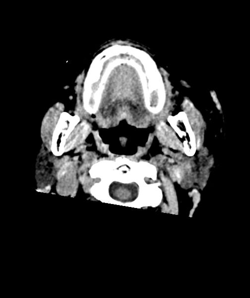 File:Acute traumatic subdural hematoma (Radiopaedia 82921-97257 Axial non-contrast 68).jpg