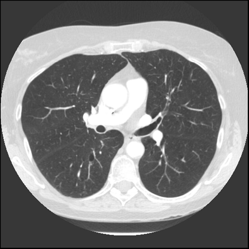 Adenocarcinoma of the lung (Radiopaedia 41015-43755 Axial lung window 56).jpg