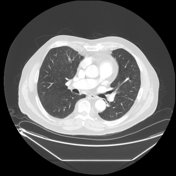 File:Adenocarcinoma of the lung (Radiopaedia 44876-48759 Axial lung window 39).jpg