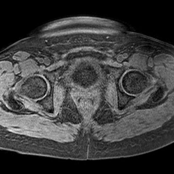 File:Adenomyoma of the uterus (Radiopaedia 9871-10439 Axial T1 fat sat 6).jpg