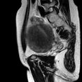 Adenomyoma of the uterus (huge) (Radiopaedia 9870-10438 Sagittal T2 3).jpg
