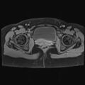 Adenomyosis and endometriotic cysts (Radiopaedia 82300-96367 Axial T1 C+ fat sat 5).jpg